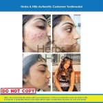 Anti-Acne Face Pack - Image 3